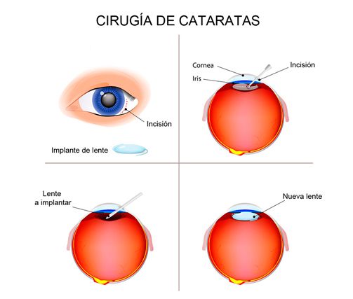 cataratas