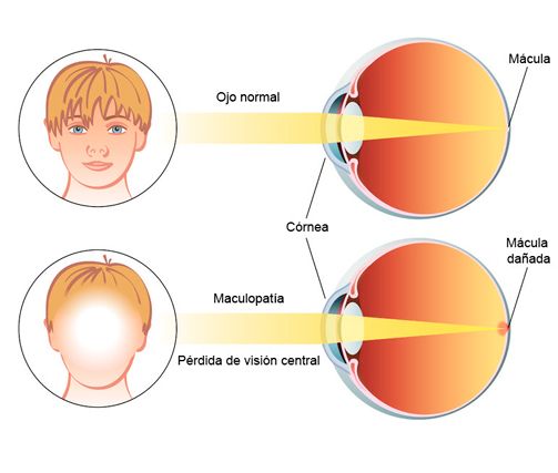 Degeneración macular asociada a la edad