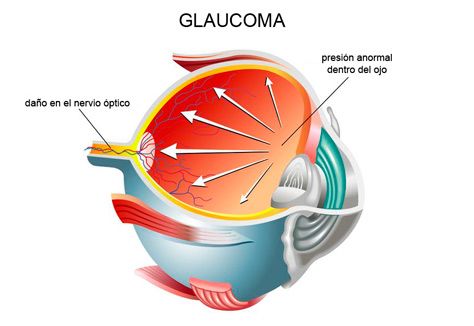 glaucoma